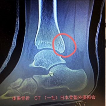 後果骨折レントゲン