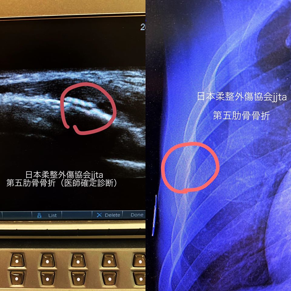 LIPUSで肋骨の骨折治癒促進