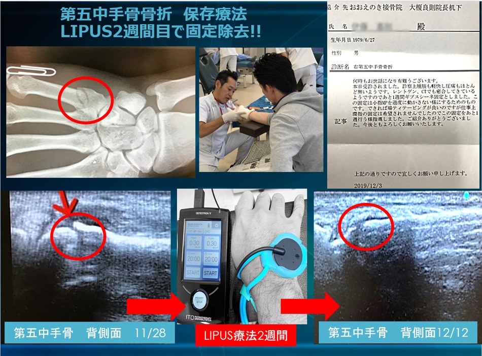 第5中足骨骨折保存療法成功事例