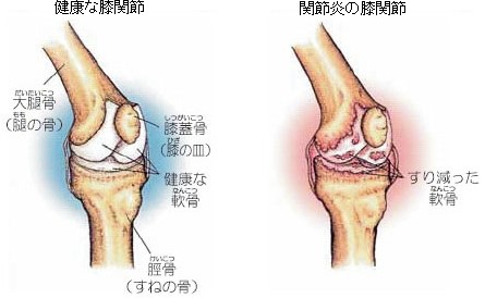 変形性関節症とは？