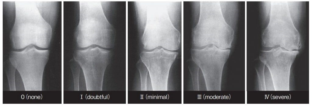変形性関節症のレントゲン画像
