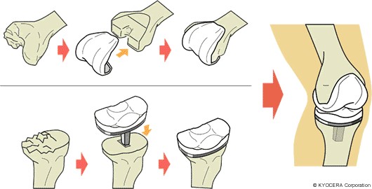 膝人工関節置換術